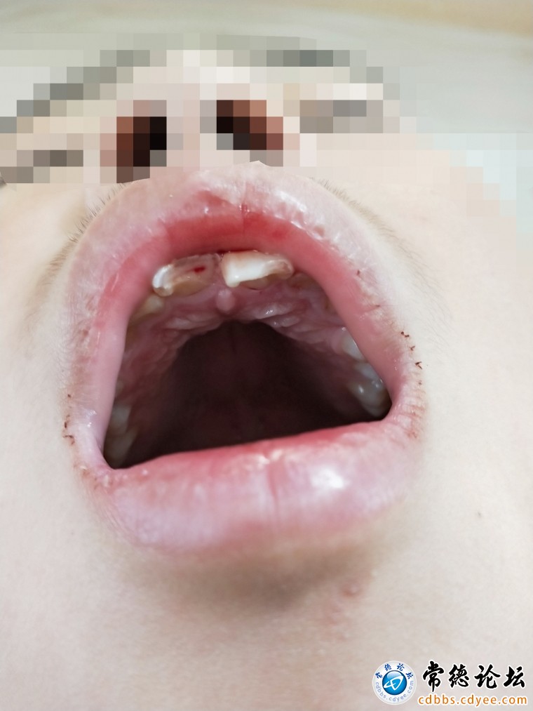 受伤照片1