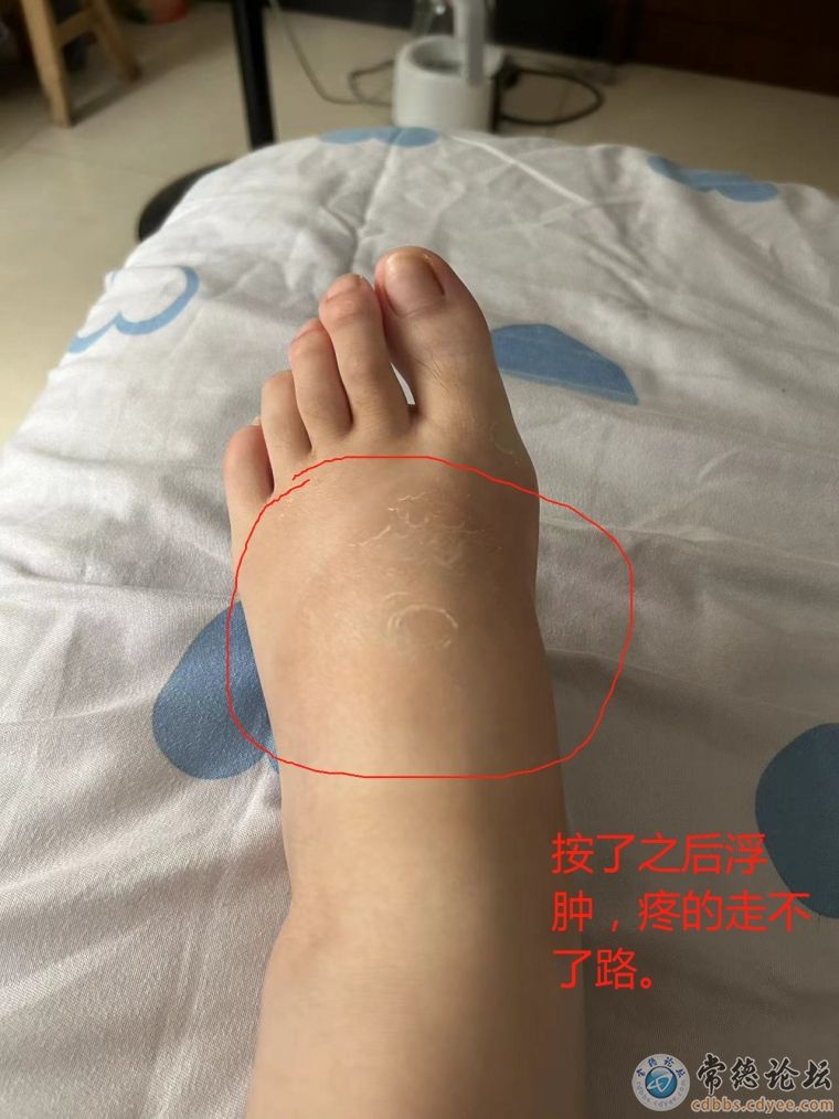 脚部严重